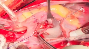 استئصال ورم من قلب طفل بقصر العيني دون التأثير على الصمام – صور