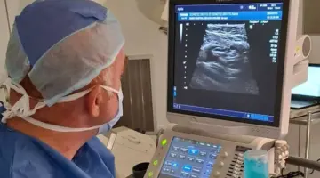 نجاح علاج ورم ليفي بالقسطرة عوضاً عن الجراحة بجامعة العاصمة